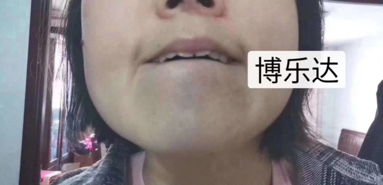 祛黑头痘印痘坑测评,净痘印去黑头精华推荐