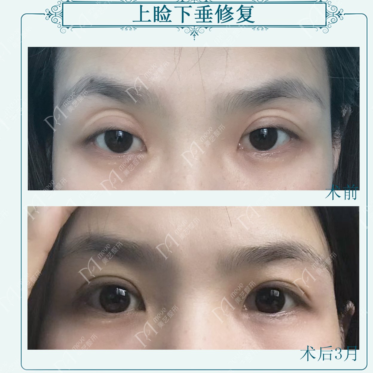 三眼皮和双眼皮哪个好看,三眼皮和二眼皮好看吗