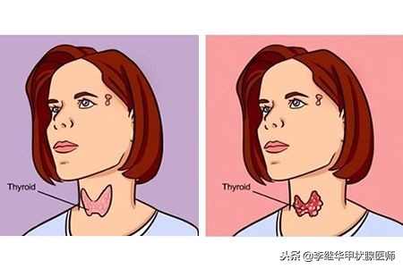 失眠焦虑心慌是甲亢吗,失眠焦虑导致严重消瘦