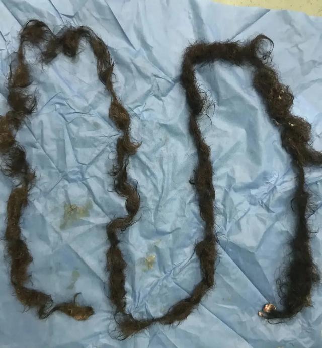 畸胎瘤里面有毛发和脂肪会复发吗,畸胎瘤是未发育成形的胎儿吗