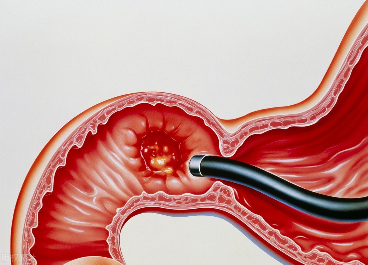 十二指肠球部霜斑溃疡有什么症状,十二指肠球部溃疡症状会后背疼吗