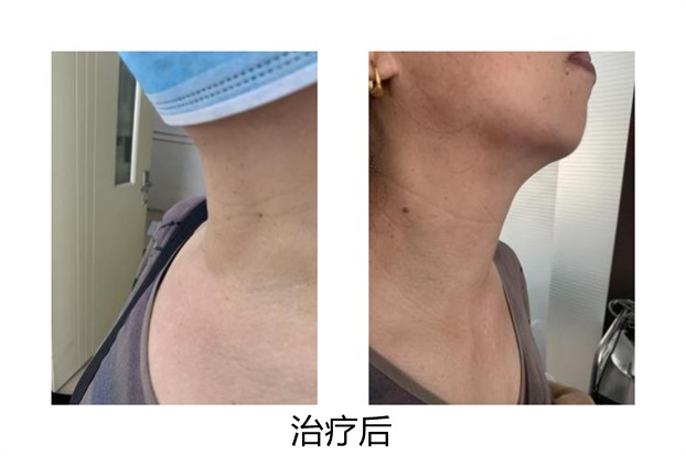 甲状腺消融术治疗甲状腺结节,甲状腺结节微创消融术器材