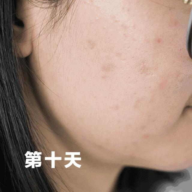 浠欎汉鎺岀棙鑲屼慨鎶よ啅,鐪嬪畬鐥樼棙浠ュ悗鎰熻鏇翠弗閲嶄簡