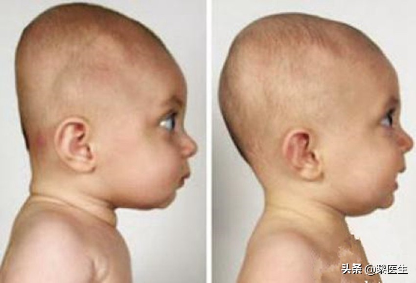 孩子佝偻病缺钙严重补钙多久见效,佝偻病是因为宝宝缺钙引起的吗