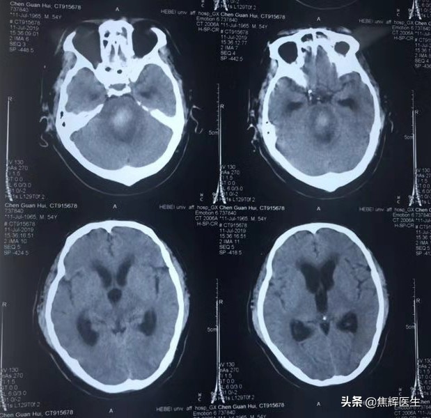 脑干出血最好的自己锻炼方法,怎么快速让脑干出血康复治愈