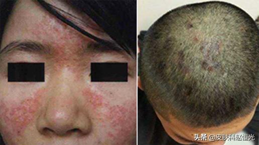 脂溢性皮炎总是反复，能治好吗？医生说其实能治愈