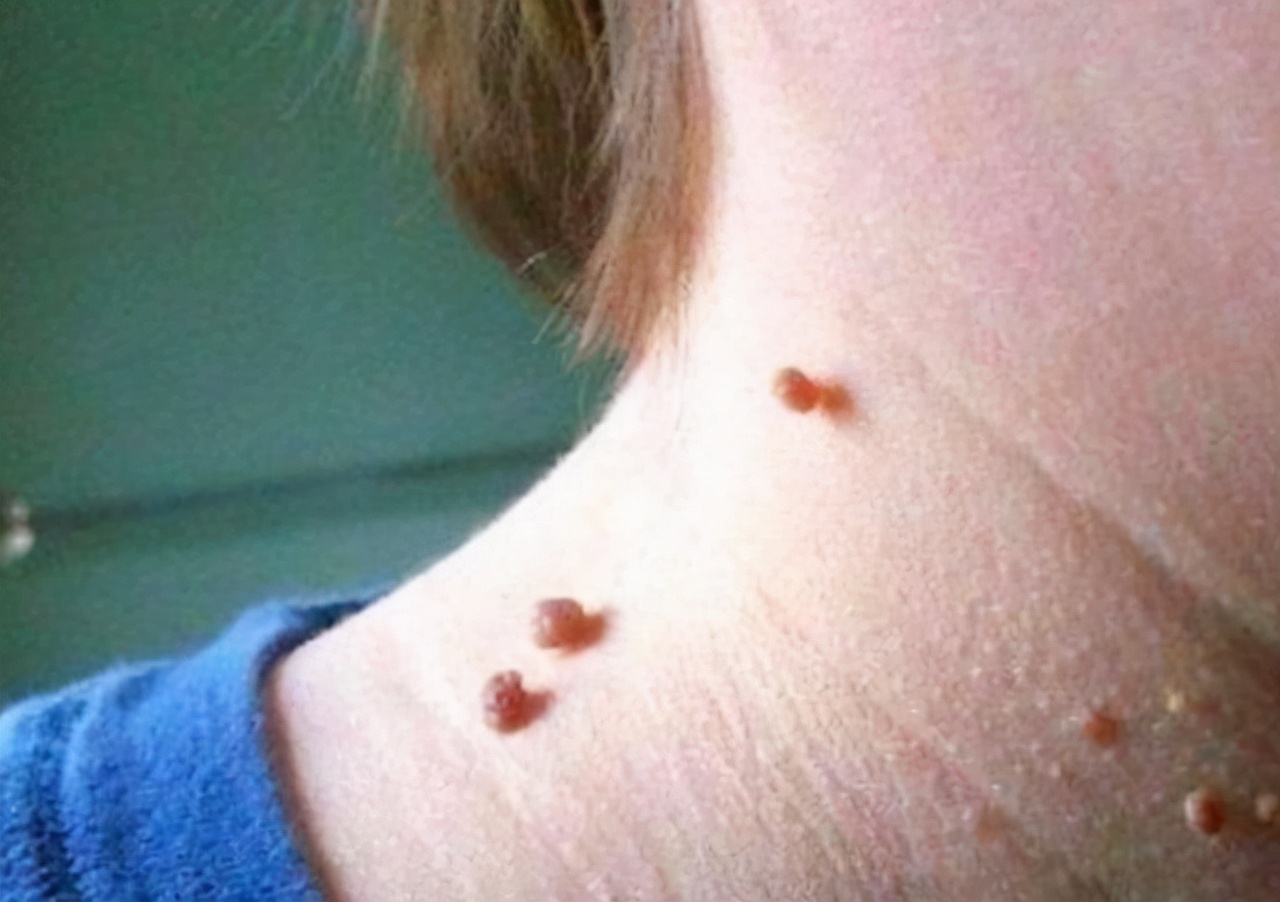 宫颈筛查有2个异常,宫颈检查病变细胞23个严重吗