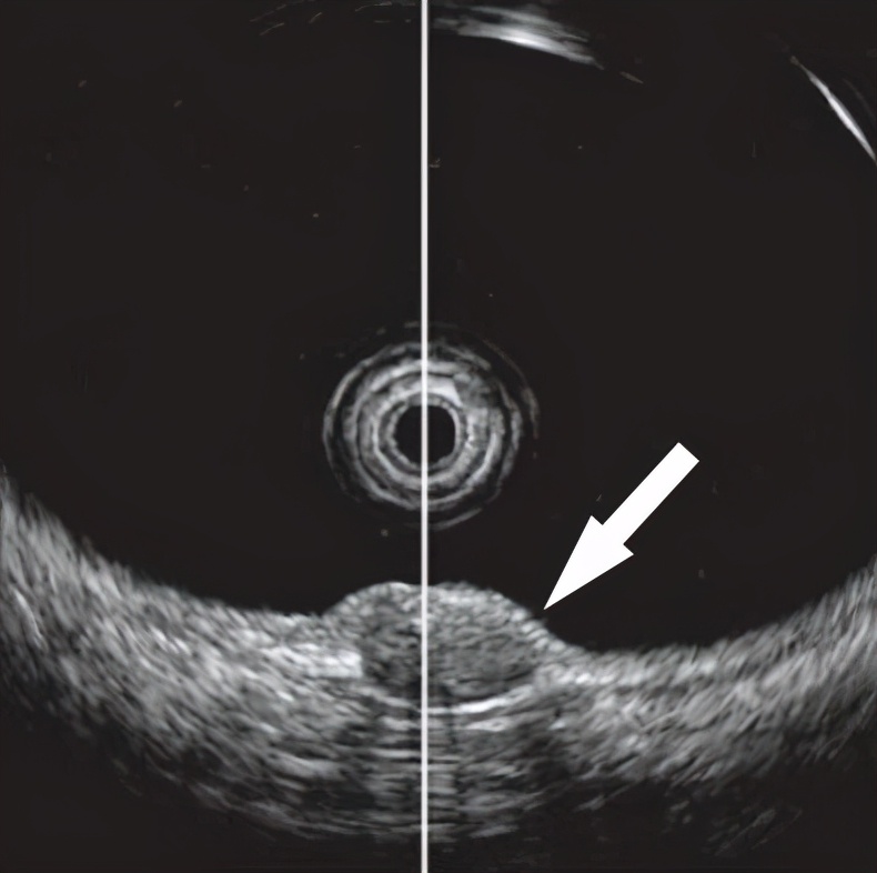 什么是大肠黏液腺癌,大肠肿瘤就是癌症有什么症状