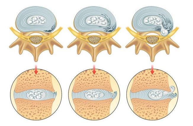 腰疼导致屁股疼需要做什么检查,腰疼屁股小腿疼痛要警惕四种病