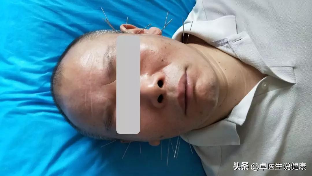 中医颊针案例分享：颈部包块20年，通过中医颊针疗法解决问题