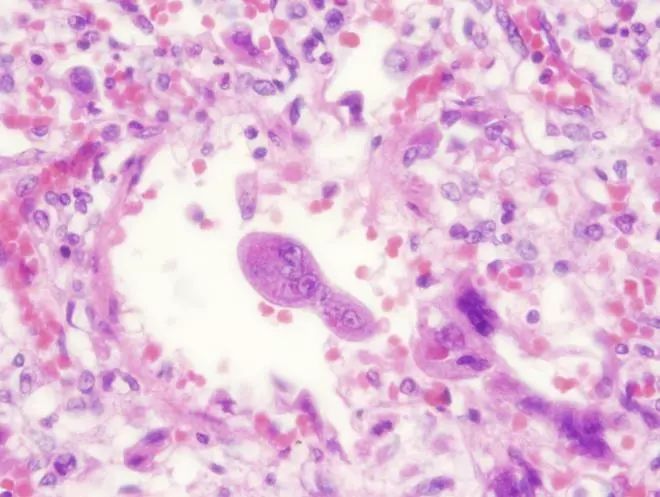 肺炎炎症图片,肺炎病历单图片