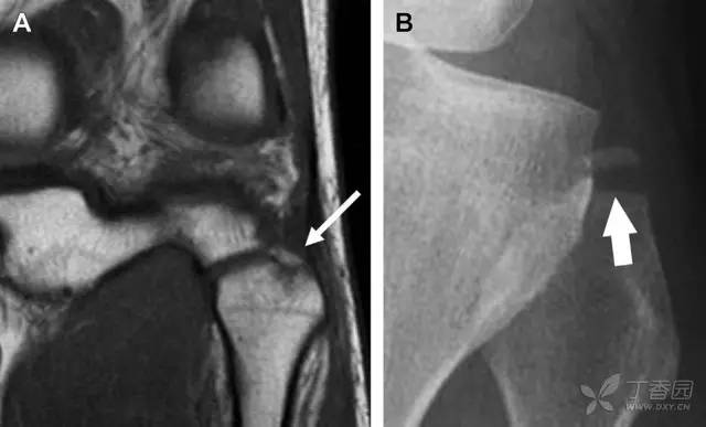 常见的八种骨折,容易漏诊的肩关节骨折