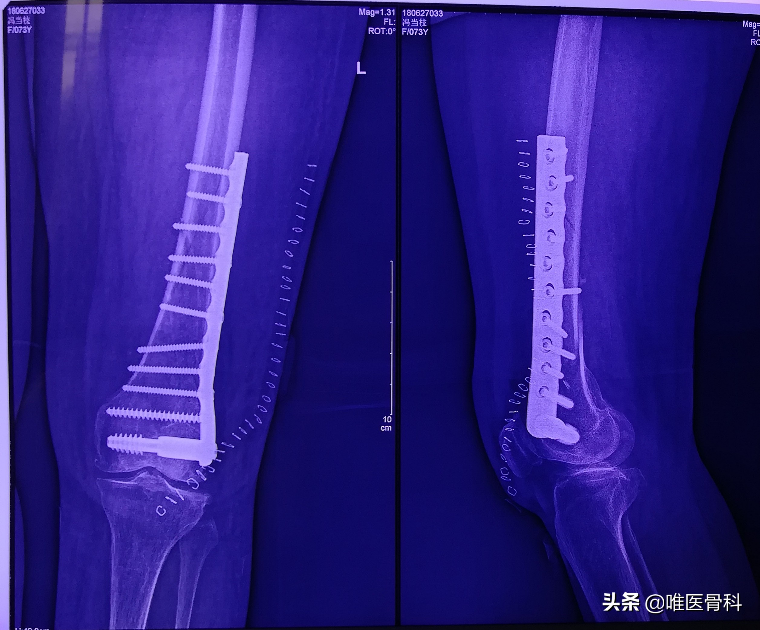 摔断腿骨头后期修复,摔断腿骨头多久能恢复