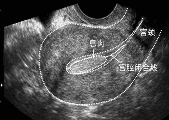 因为内膜问题反复怀孕胎停,经常怀孕失败的原因