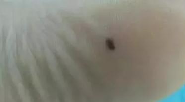 医生点痣,市人民医院能点痣吗