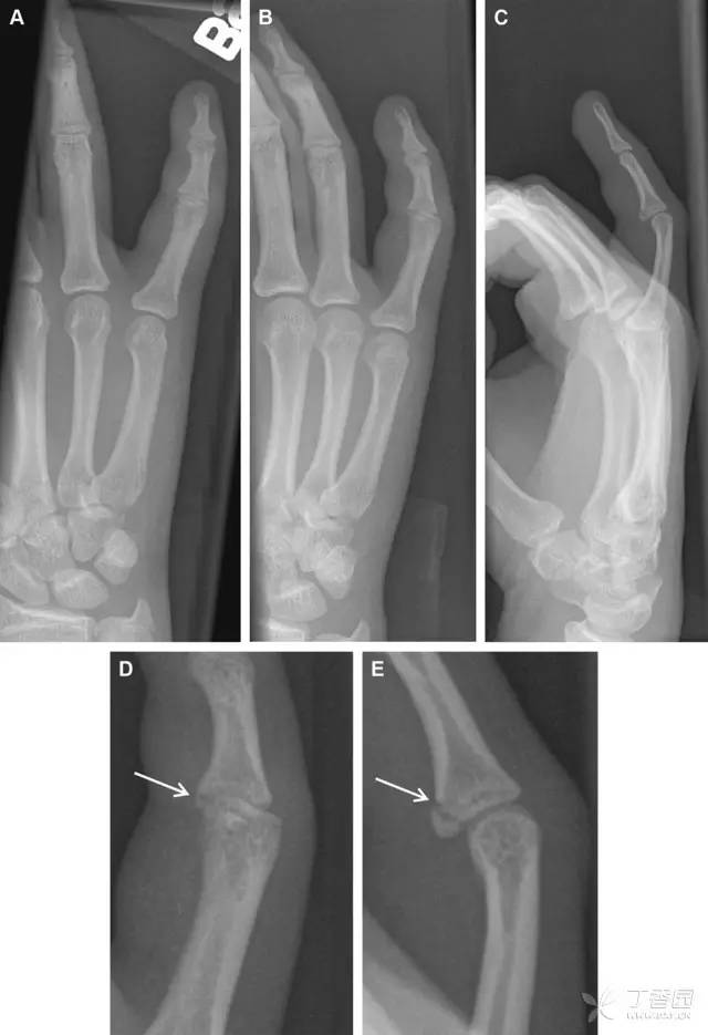 常见的八种骨折,容易漏诊的肩关节骨折
