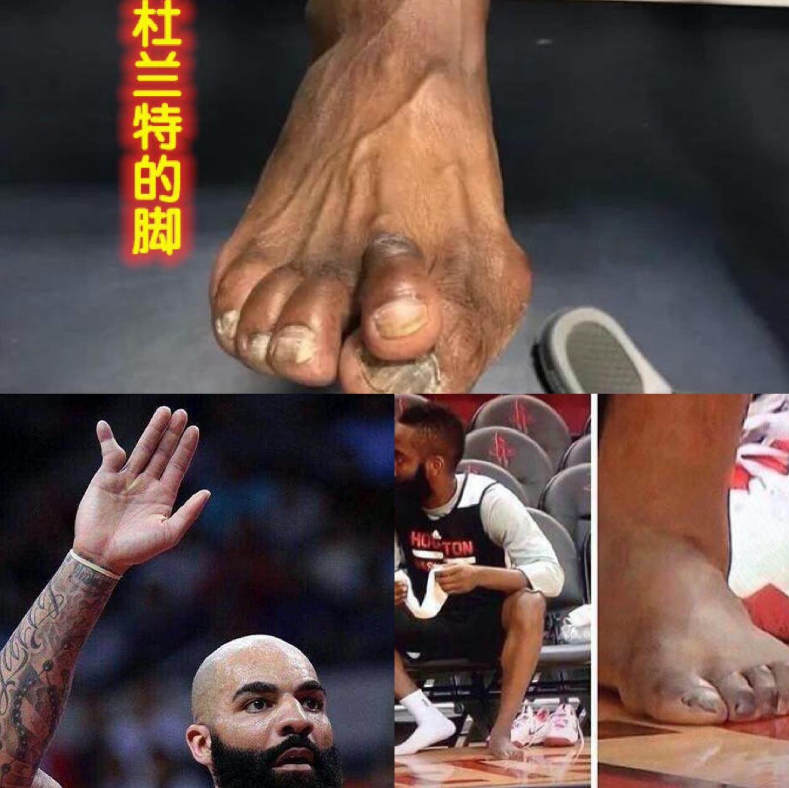 伤不起！NBA球员：伤不起的手指脚趾