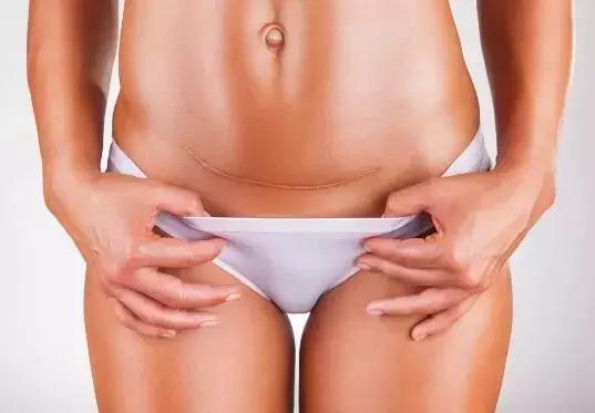 切口妊娠前期关注事项,切口妊娠怎么保胎