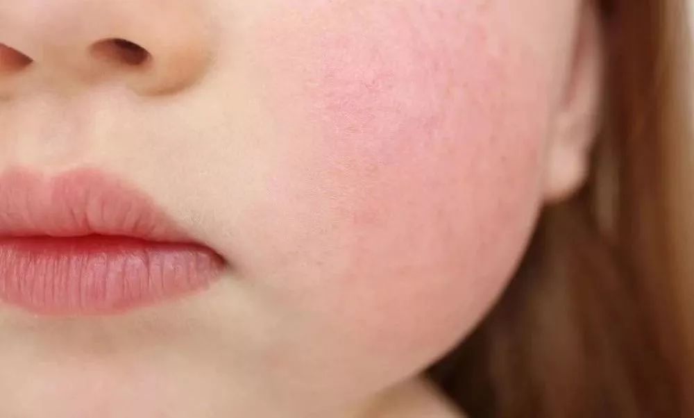 「健康」孩子感冒、嗓子疼要消炎吗？谨慎用错消炎药害了娃