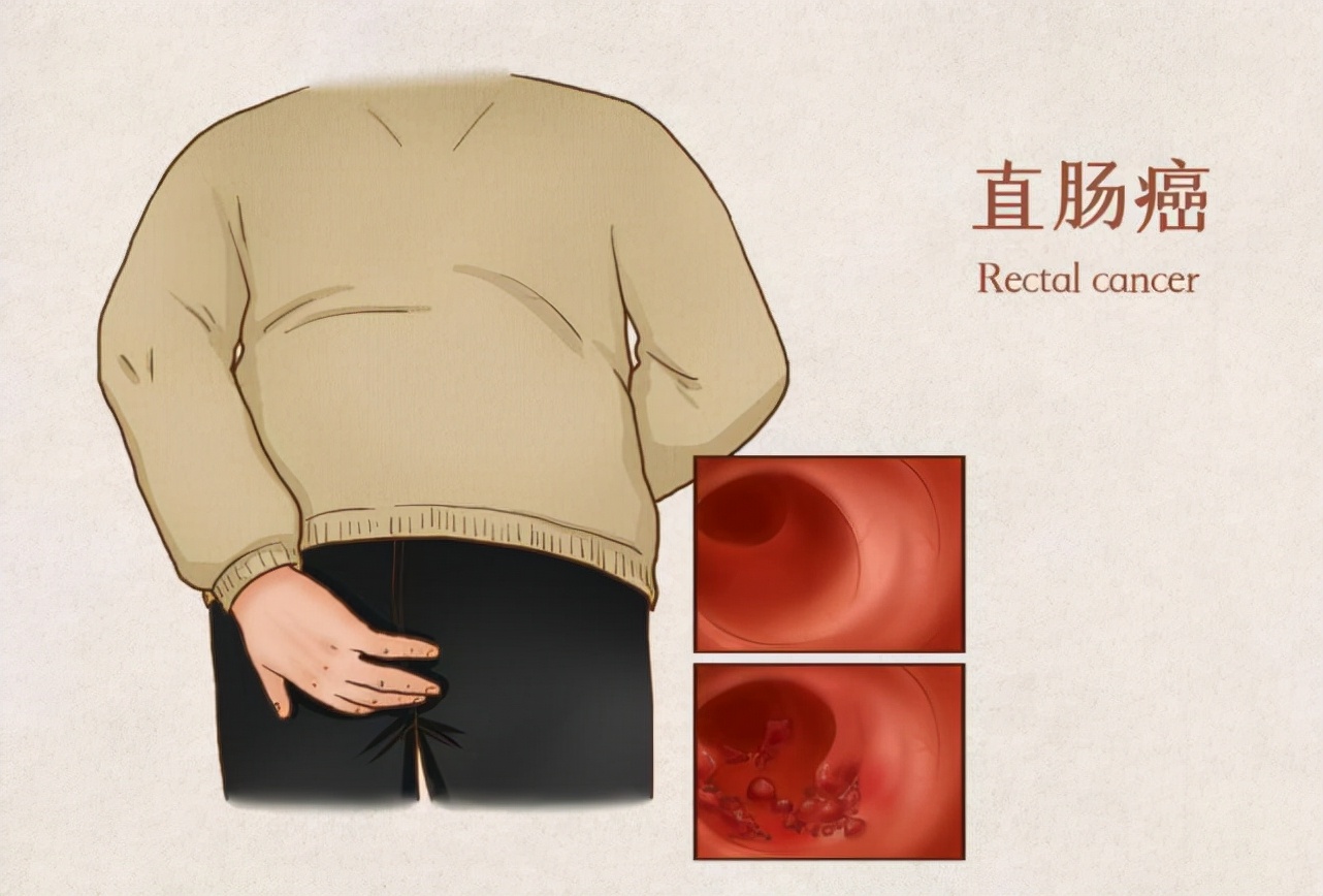 直肠癌手术后便血怎么治疗,直肠癌手术大便便血是怎么回事