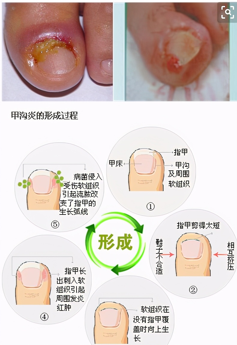 甲沟炎有什么需要关注的事项,甲沟炎恢复过程中会遇到的问题