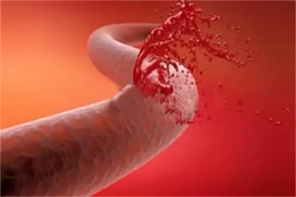 血小板减少会怎样补,血小板减少会怎样后果