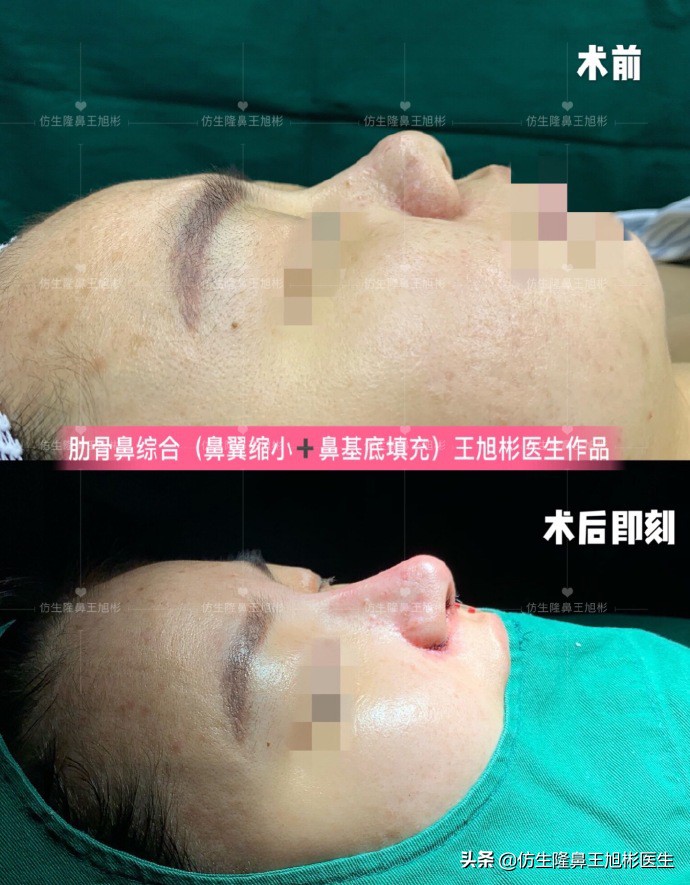 鼻头肥大矫正加鼻翼缩窄案例,鼻头缩小术后