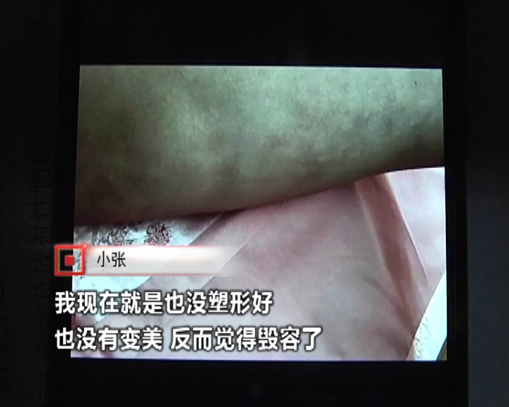 女子花费一万五千元抽脂,女子花三万抽脂术后效果引争议