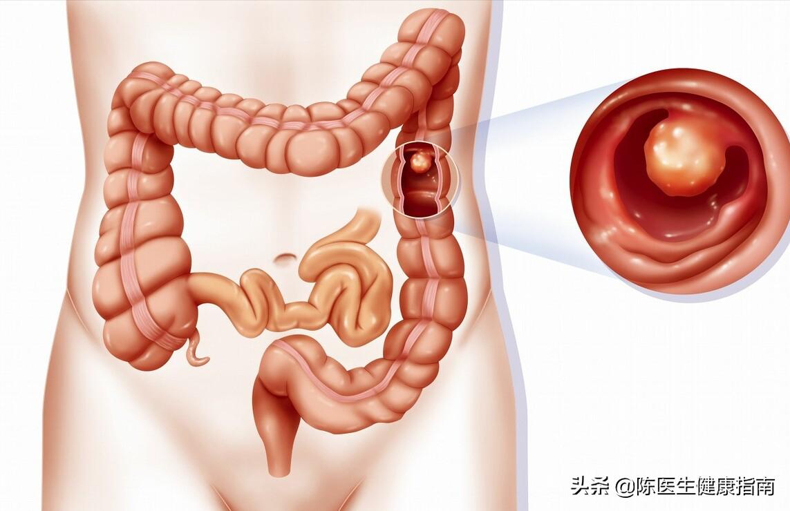 肠内有息肉都会出现哪些症状,肠内有息肉会有何症状