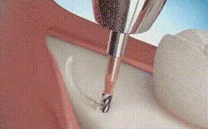 智齿到底要不要拔掉专家告诉你,有什么办法治疗智齿