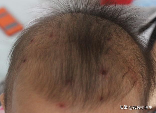 手足口病容易和哪些病混淆,儿科医生手足口病