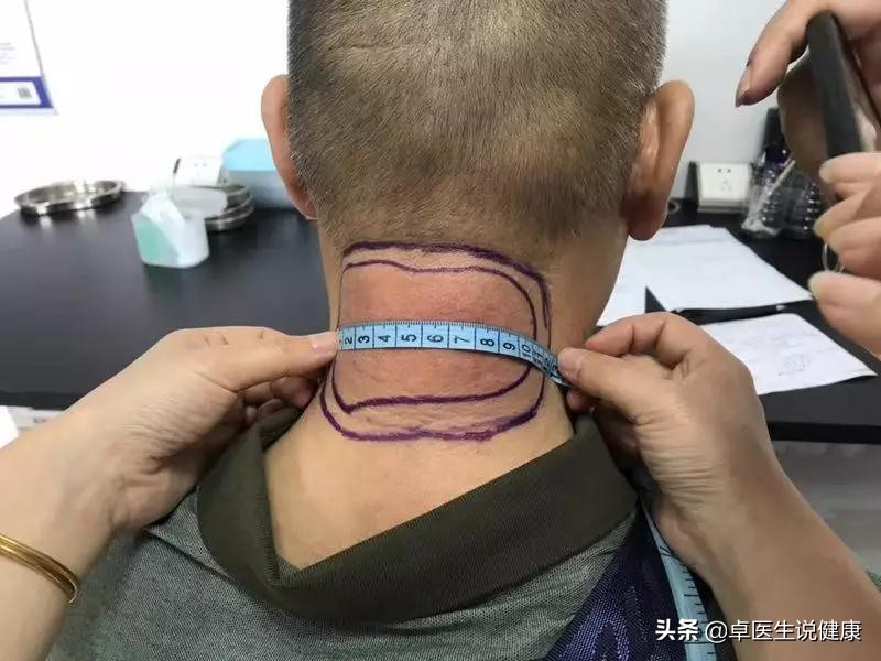 中医颊针案例分享：颈部包块20年，通过中医颊针疗法解决问题