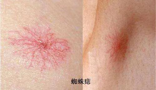 乙肝患者皮肤发黄还意味着什么,乙肝患者皮肤出现红点