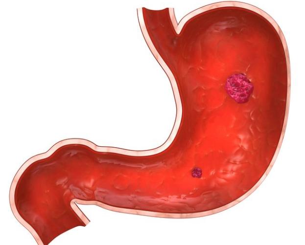 胃病吃啥药都没效果还越来越严重,胃病吃什么胃药好