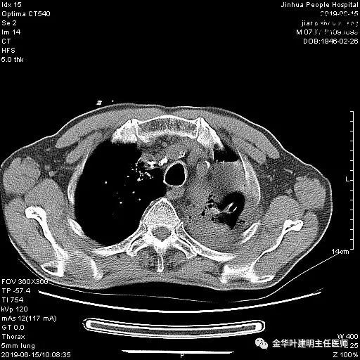 手术引起乳糜胸,有没有做了肺结节手术后是误诊的