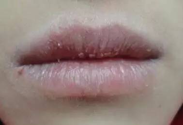 嘴唇干裂起皮撕流血了该怎么办,嘴唇干裂起皮是什么原因引起的