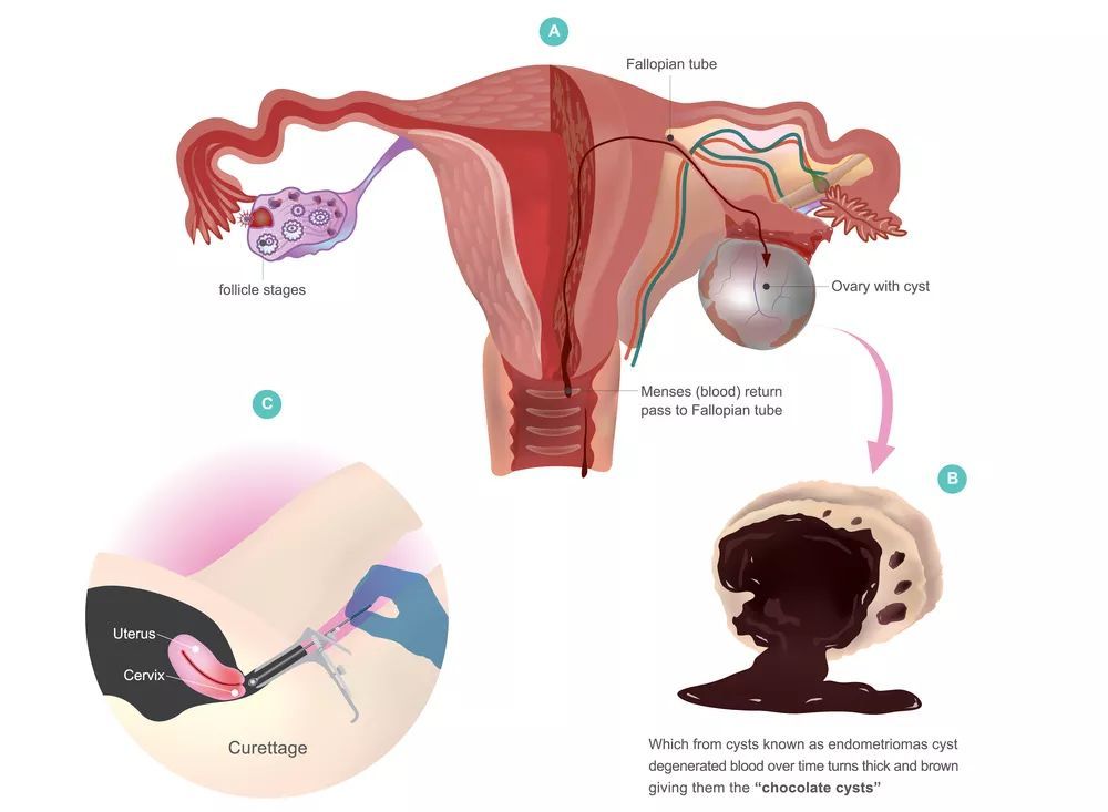 青春期少女巧克力囊肿,女性青春期卵巢肿瘤