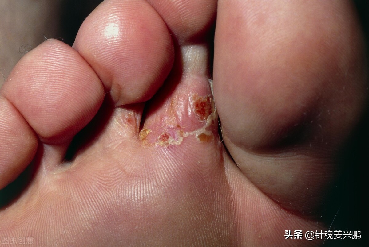 脚气真菌如何治才能根除,真菌脚气如何治才能根除