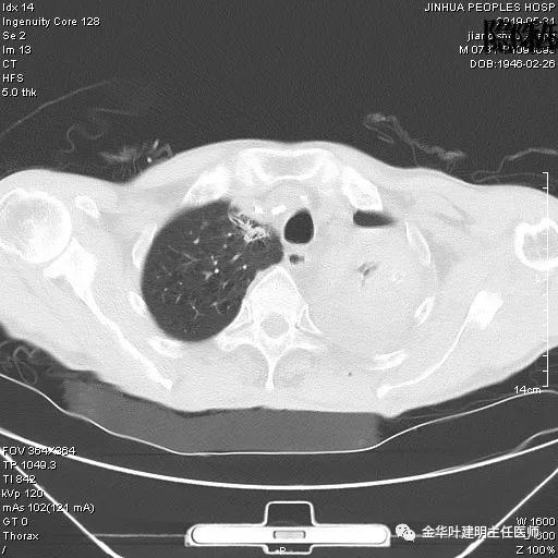 手术引起乳糜胸,有没有做了肺结节手术后是误诊的