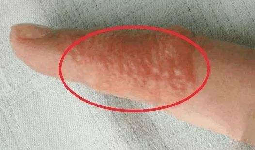 湿疹的症状有哪些如何预防湿疹,湿疹怎么预防最好的方法