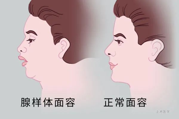 腺样体肥大用艾呼吸有用吗,腺样体肥大如何纠正口呼吸