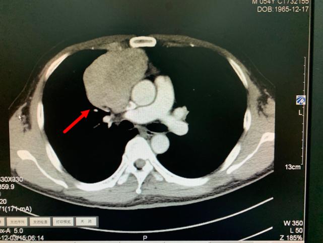 胸腔有拳头那么大的瘤严重吗,胸腔长了个八公分囊性肿瘤