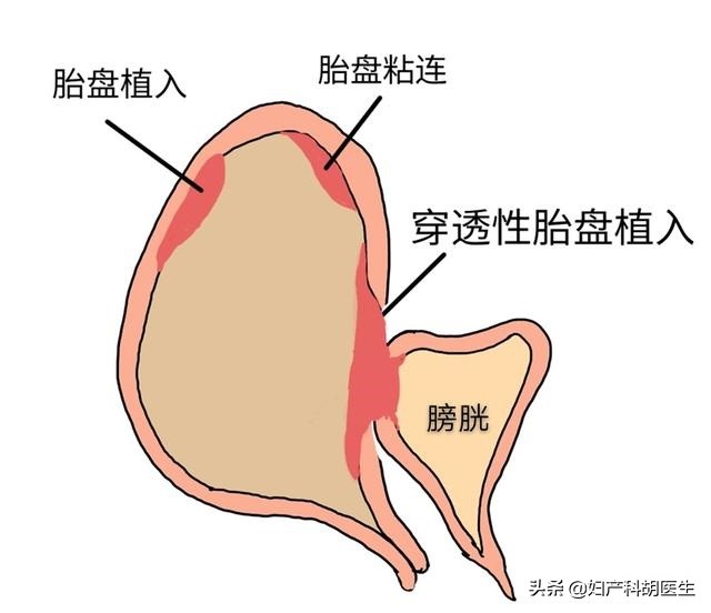 徒手剥离胎盘失败一定要清宫吗,徒手剥离胎盘操作流程