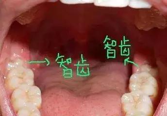 智齿冠周炎引起的下颌骨疼痛,智齿冠周炎张口受限伴吞咽疼痛