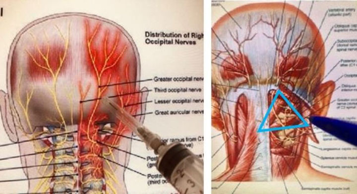 头痛导致耳神经也痛,枕神经疼会引起头顶痛眼睛胀痛吗