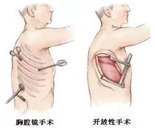 早筛早诊防肺癌,肺癌早诊早治可治愈