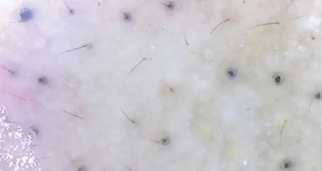 消灭黑头，男女都一样，颜值加倍