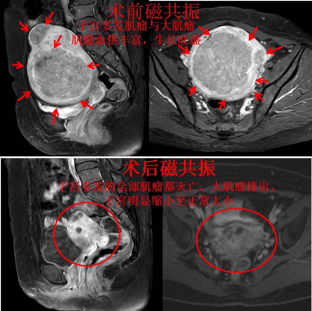 多发子宫肌瘤到底长在哪里了,子宫肌瘤一堆怎么治疗