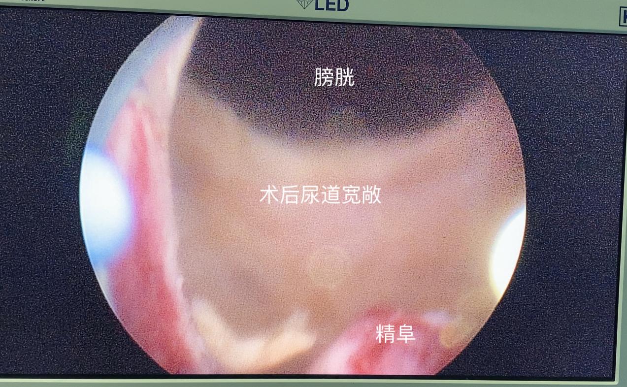 治疗前列腺增生什么方法最靠谱,前列腺增生何种方式治疗效果最好
