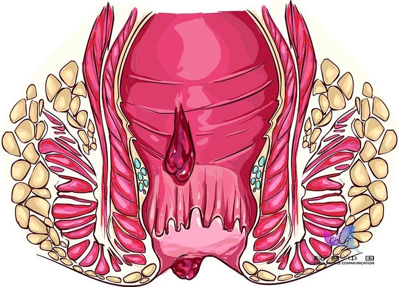 不敢相信！十人九痔竟与这习惯有关！很多人不知道！